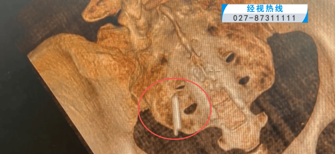 体温表在体内断裂，女子时隔22年彻底取出！医生：庆幸水银不在里面